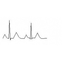 ekg 001